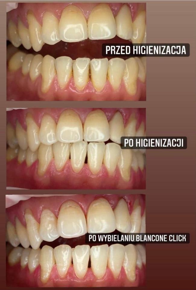 Blancone wybielanie + higienizacja