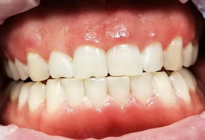 Zęby po higienizacji